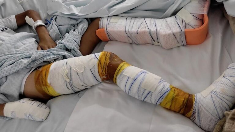 Criança que teve pés queimados em Três Barras passa por cirurgia de seis horas