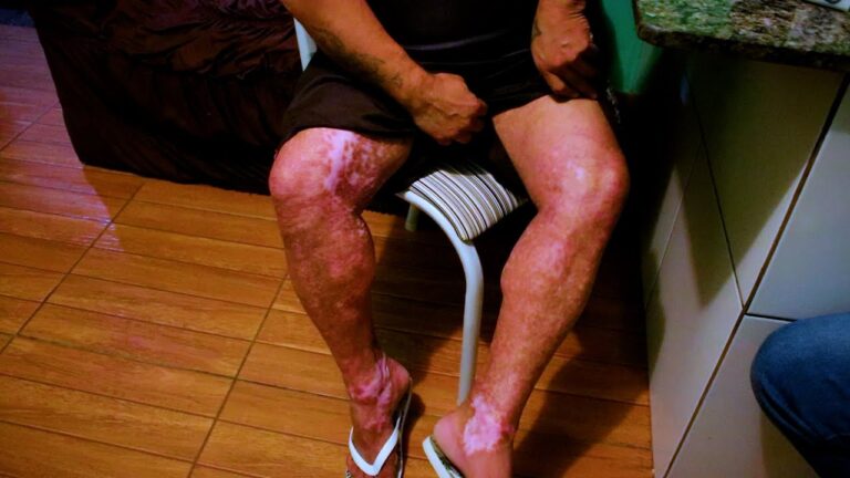 Homem teve o corpo queimado no mesmo local em que criança se feriu em Três Barras