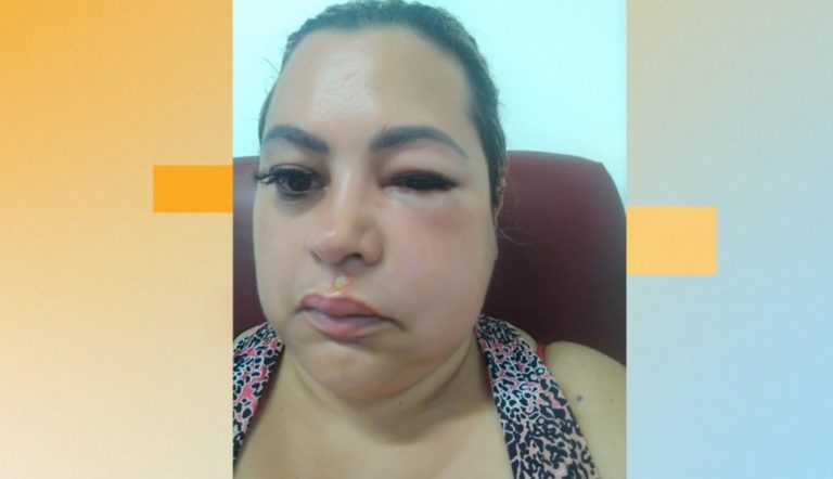 Infecção rara: como um dente de leite quase custou a vida de empresária da região